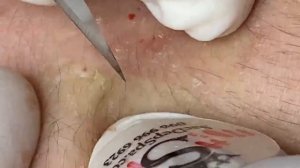 Выдавливание прыщей, угрей, черных точек и камедонов #239