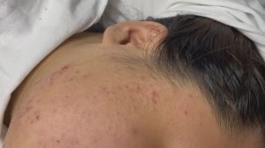 Избавление от белых точек(милиумов) Win #135