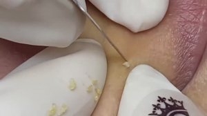 Терапия открытых комедонов - SDS#174