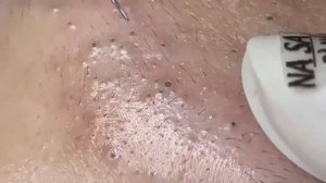 Asmr. Профессиональное очищение от прыщей и белых точек. #887625