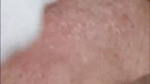 Чистка лица от угрей и акне. Выдавливание прыщей. Удаление черных точек и комедонов