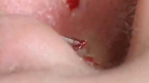 #50 Чистка лица от угрей и акне. Выдавливание прыщей. Удаление черных точек и комедонов