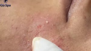 Asmr. Чистка лица от угрей.