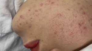 Механическая чистка от закрытых комедонов: основной метод удаления Win #134