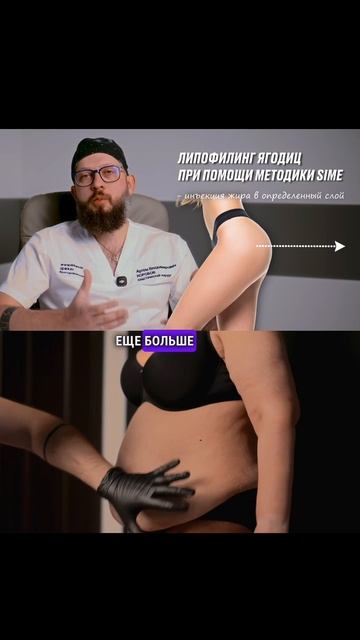 Почему липофилинг ягодиц может быть опасен? Главный риск