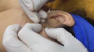 Пигментация после акне | Следы от прыщей в виде темных пятен - SDS#172