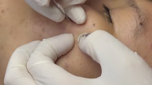 Темные пятна после прыщей (гиперпигментация) - ТТ#76