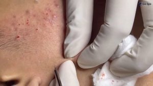 Asmr. Профессиональная чистка от акне.