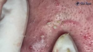 Чистка кожи от белых точек и черных точек: комплексный подход