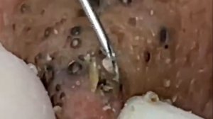 Чистка лица от угрей и акне. Выдавливание прыщей. Удаление черных точек и комедонов