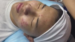 Профессиональное очищение кожи от прыщей и милиумов Win #129