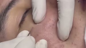 Лечим закрытые комедоны: частный случай.