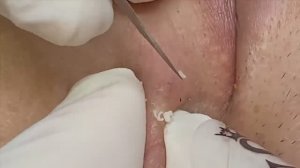 Подкожные прыщи | Удаление скрытых прыщей под кожей - SDS#170