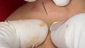 Лечение черных точек и скрытых прыщей на коже - SDS#171