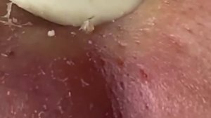 Чистка лица от угрей и акне. Выдавливание прыщей. Удаление черных точек и комедонов