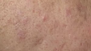 Черные точки | Как лечить черные точки - SDS#166