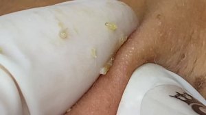 Глубокие черные точки под кожей - #ТТ61