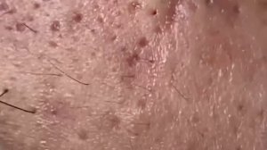 Удаление белых точек (милиумов) у косметолога 𝐖𝐢𝐧 #𝟏𝟎𝟎𝟐