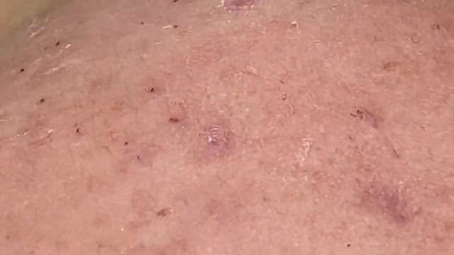 Очищение кожи от глубоких закрытых комедонов - SDS#178