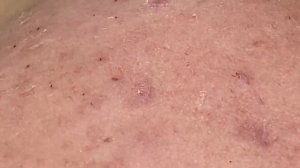 Очищение кожи от глубоких закрытых комедонов - SDS#178