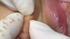 Профессиональное избавление от белых угрей