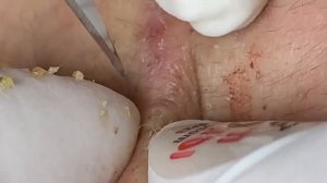 Выдавливание прыщей, угрей, черных точек и камедонов #240