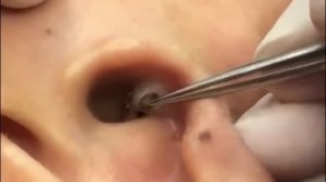 Чистка лица от угрей и акне. Выдавливание прыщей. Удаление черных точек и комедонов