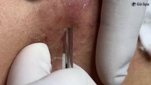 Глубокое очищение пор от белых точек