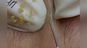 Выдавливание прыщей, угрей, черных точек и камедонов #241