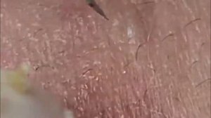 Чистка лица от угрей и акне. Выдавливание прыщей. Удаление черных точек и комедонов