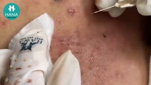 Механическое очищение кожи от милиумов: только у специалиста HANA #40