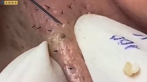 Удаление милиумов у косметолога: тонкая работа. #887627