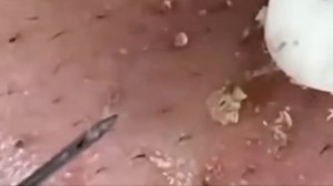 Чистка лица от угрей и акне. Выдавливание прыщей. Удаление черных точек и комедонов