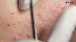 Не верьте глазам: под кожей скрывается много прыщей!