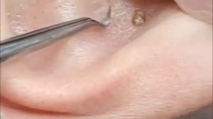 Чистка лица от угрей и акне. Выдавливание прыщей. Удаление черных точек и комедонов