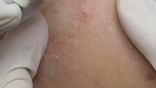 Удаление прыщей на шее - SDS#175