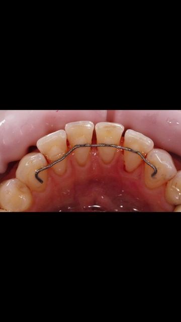 Профессиональная гигиена с ретейнерами: Убираем налет и камень (До/После)