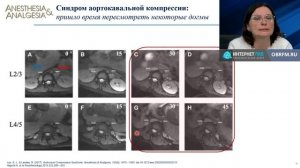 Анестезия кесарева сечения Упрямова Е.Ю. 2025