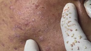 Лечение милиумов (просянки): удаление Linh #12