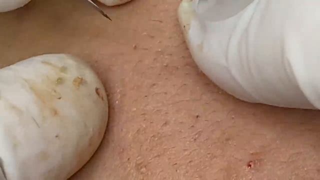 Лечение акне для подростков - SDS#180