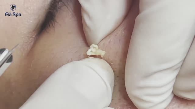 Сеанс лечения угревой сыпи — 40 минут чистки  GA