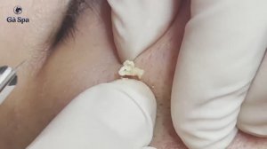 Сеанс лечения угревой сыпи — 40 минут чистки  GA