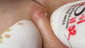 Выдавливание прыщей, угрей, черных точек и камедонов #242