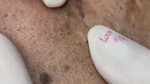 Asmr. Профессиональное очищение от прыщей и белых точек. #887583