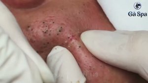 55 минут удаления черных точек — Это просто кайф!! GA