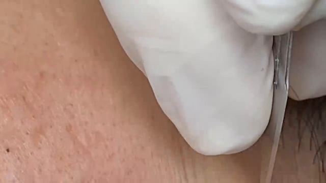 Удаление прыщей на шее  SDS175