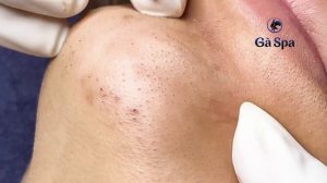 Лечение акне: особое внимание скрытым прыщам