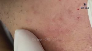 Шедевральный случай удаления прыщей ВЕРНУЛСЯ!!!