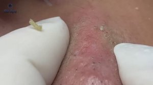 Если ты фанат выдавливания прыщей, ты просто должен это увидеть | Полные 33 минуты   GA