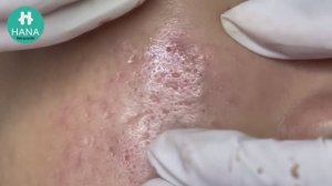 Избавление от угрей и белых точек(милиумов) HANA #53